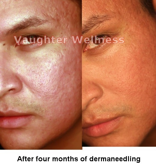 Acne scars before and after dermarolling