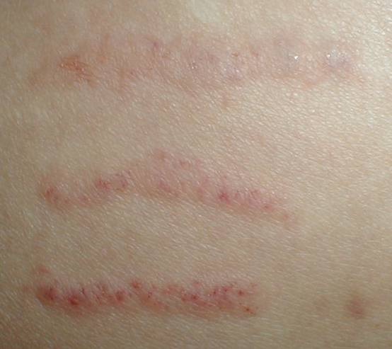 single-needled skin